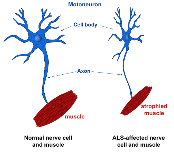 beza saraf normal dan ALS