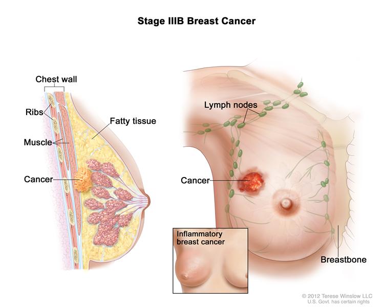 kanser-payudara-tanda
