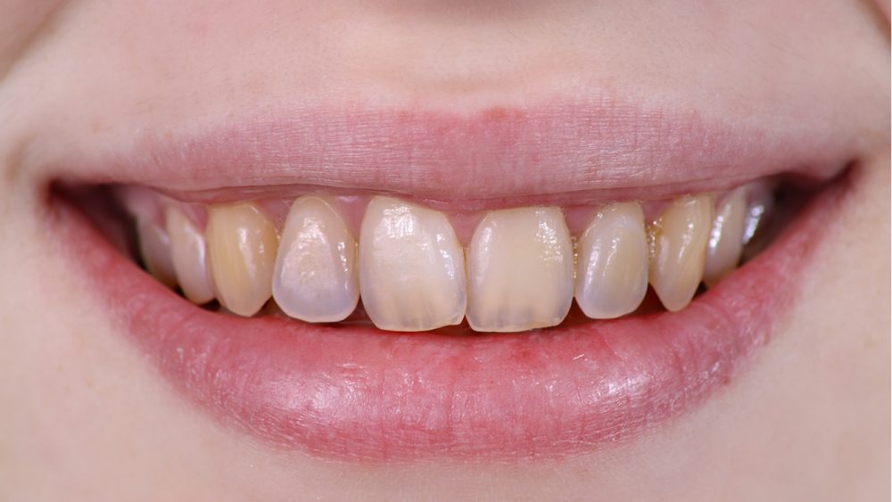  Gigi  Kuning Lebih Sihat Berbanding Gigi  Putih Wanista com